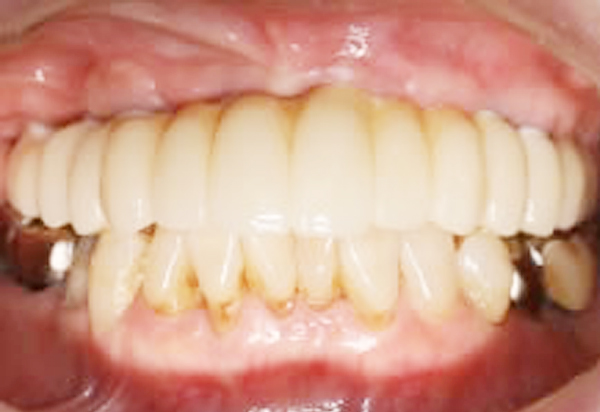 上顎全歯欠損・金属を使わない上部構造 金属を使わない人工の歯（上部構造）で治療 After