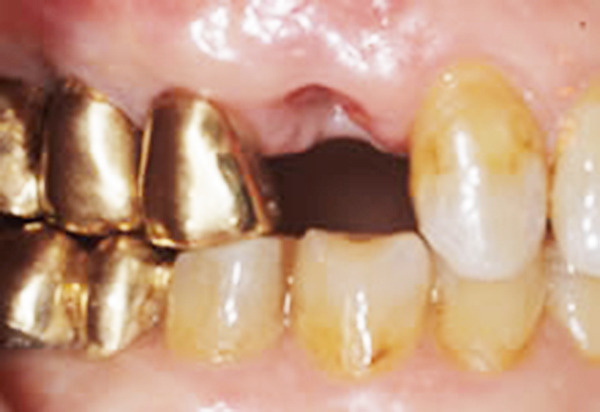 奥歯の1歯欠損（60代男性）右下６番欠損(右下の奥歯(大臼歯)１本の欠損)Before