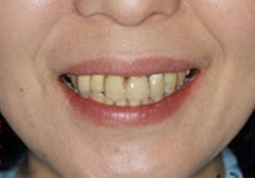 前歯の将来を考えた審美治療 前歯4本を審美面を重視した治療 Before