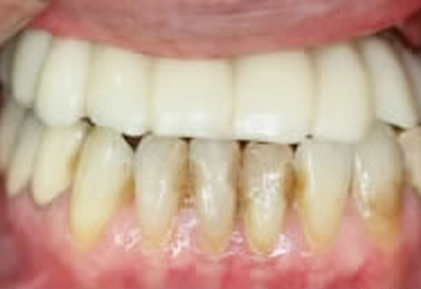 1日で噛めるインプラント・全歯欠損 上あご　全歯欠損 After