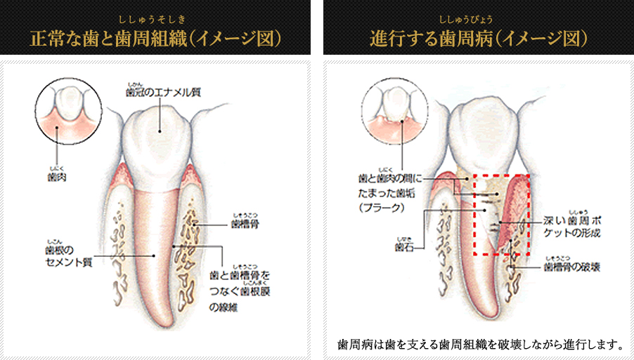 正常な歯と歯周組織（イメージ図）進行する歯周病（イメージ図）