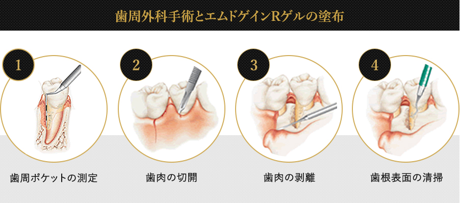 歯周外科手術とエムドゲインRゲルの塗布