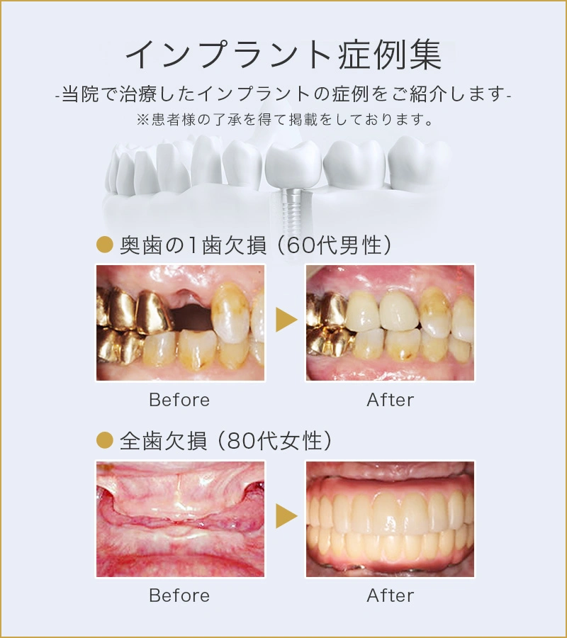 インプラント症例集